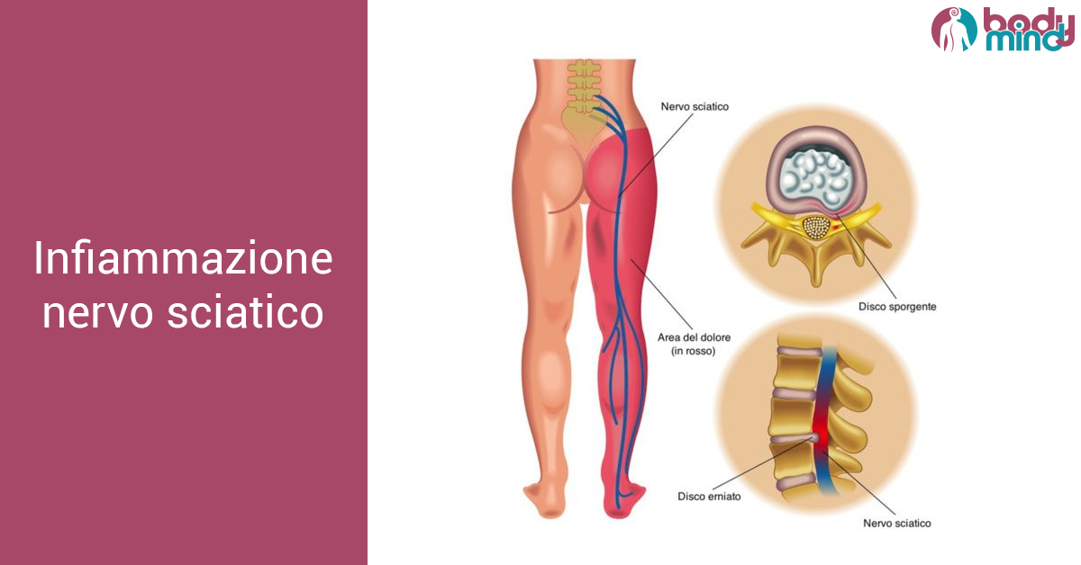 Nervo Sciatico Infiammato Cause E Rimedi Per La Sciatica Studio Bodymind